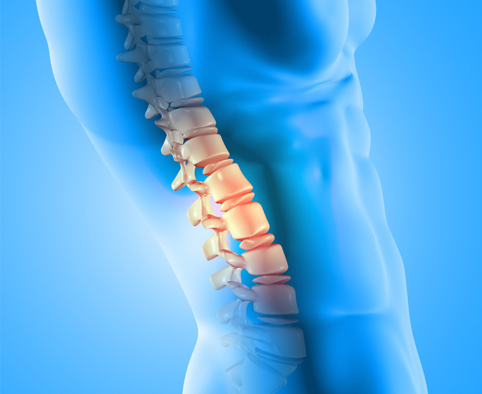 Medicinska ilustracija ljudske kičme prikazuje detaljan prikaz problema sa diskushernijom i išijasom. Slika prikazuje pršljenove u plavoj boji sa izraženim diskovima, od kojih su neki označeni u narandžastoj boji kako bi se istakli kao problematični ili oštećeni. Ova vizualizacija omogućuje jasno razumijevanje mjesta gdje diskovi pritiskaju na živčane korijene, što uzrokuje bol i nelagodu tipičnu za išijas.